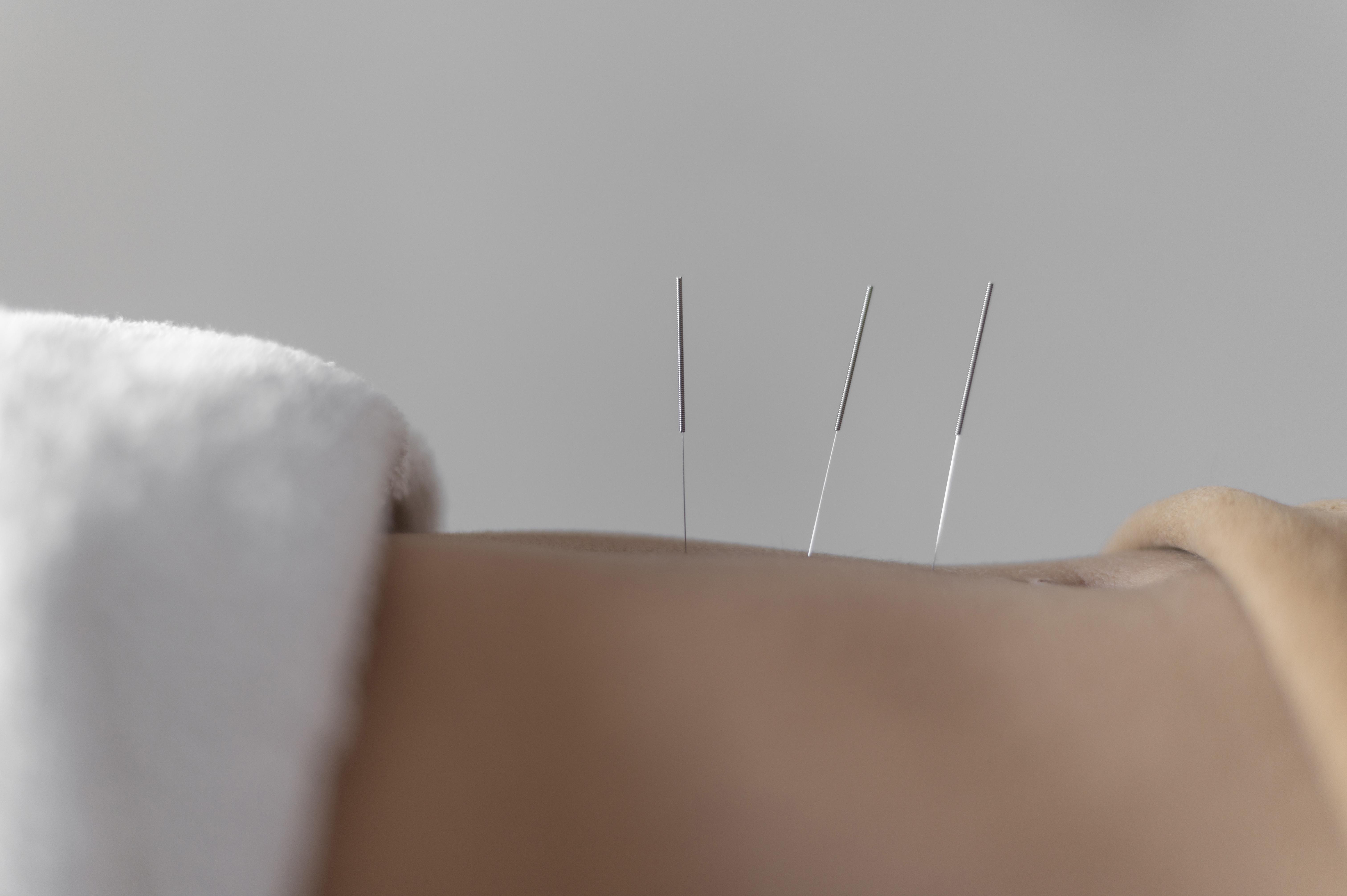dry needling in physical therapy